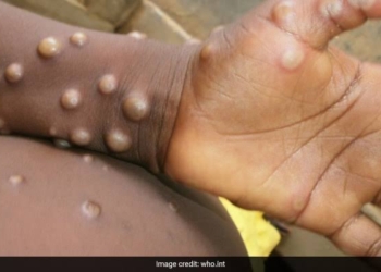 WHO: Nearly 200 Cases of Monkeypox in More Than 20 Countries