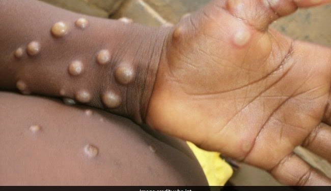 WHO: Nearly 200 Cases of Monkeypox in More Than 20 Countries