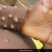 WHO: Nearly 200 Cases of Monkeypox in More Than 20 Countries