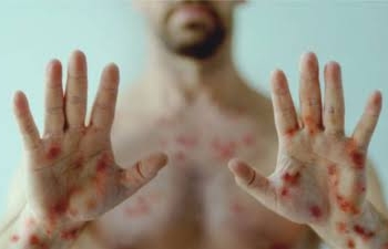 No cause for panic over Monkeypox, says AIIMS professor Sanjay Rai at Kashmir conference