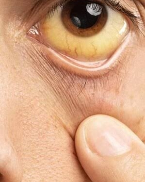Jaundice Outbreak Reported in Srinagar’s Bohri Kadal; 12 Cases Detected