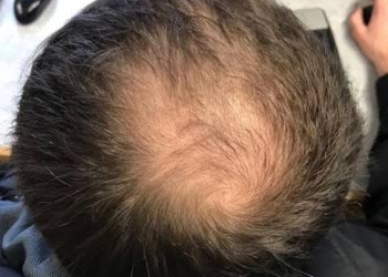 SCIENTIFIC BREAKTHROUGH: “First Major Cure” for Male Baldness in 30 Years Unveiled