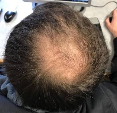 SCIENTIFIC BREAKTHROUGH: “First Major Cure” for Male Baldness in 30 Years Unveiled
